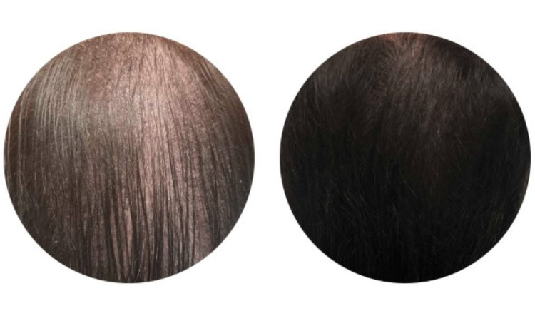 forradalmi_technologia_a_hajfiatalitas_vilagaban_denza_lezeres_hajkezeles_