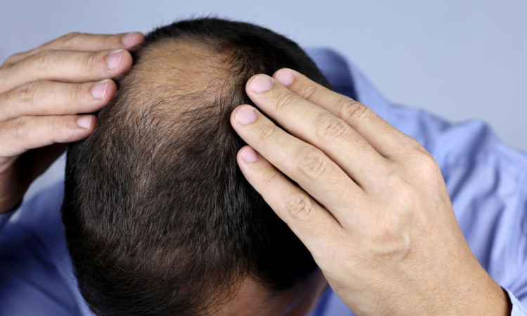 hajuhullas_ellen_a_ferfias_tipusu_hajhullas_okai_es_megoldasai_