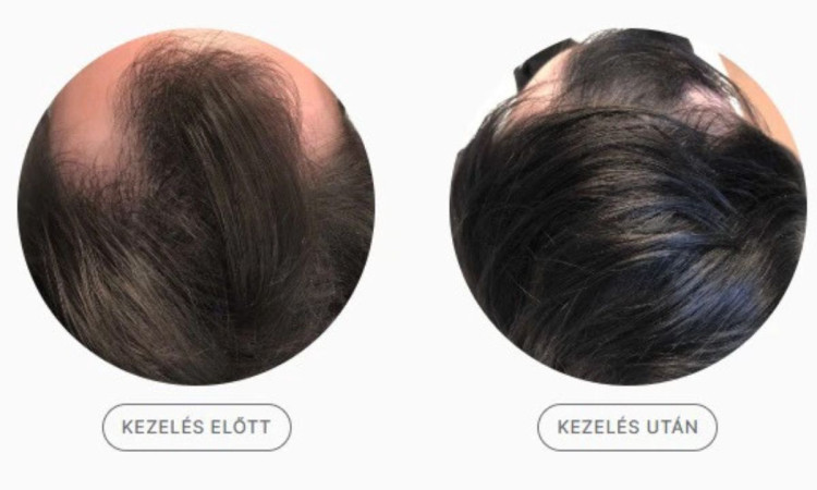 lezeres_hajkezeles_hajhullas_ellen_dus_es_eros_haj lezeres_hajkezeles_hajhullas_ellen_dus_es_eros_haj