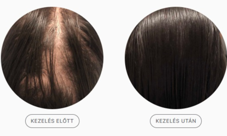 hormonok_es_hajhullas_hogyan_kezelheto_a_pajzsmirigyproblemak_okozta_hajhullas hormonok_es_hajhullas_hogyan_kezelheto_a_pajzsmirigyproblemak_okozta_hajhullas