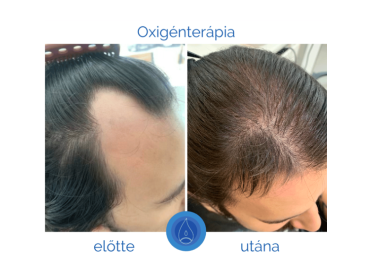 alopecia_es_tipusai