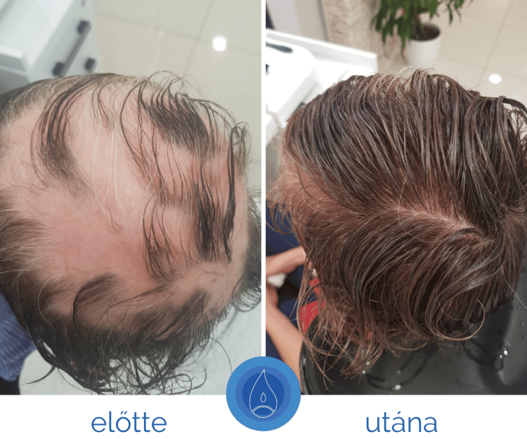 kronikus_hajhullas_okai_es_kezelese kronikus_hajhullas_okai_es_kezelese