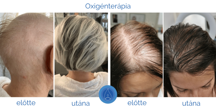 kronikus_hajhullas_okai_es_kezelese kronikus_hajhullas_okai_es_kezelese