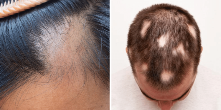 alopecia_es_tipusai