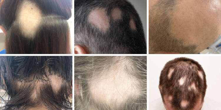 mit_tehetunk_a_foltos_kopaszodas_ellen