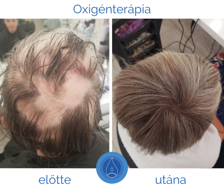 mit_tehetunk_a_foltos_kopaszodas_ellen