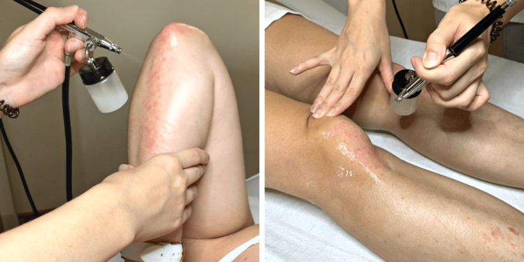 pikkelysomor_kezelese