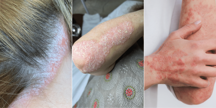 pikkelysomor_kezelese