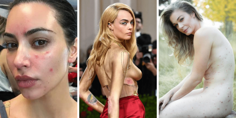 pikkelysomor_kezelese