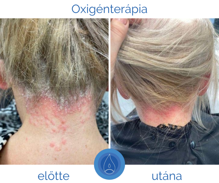 pikkelysomor_kezelese