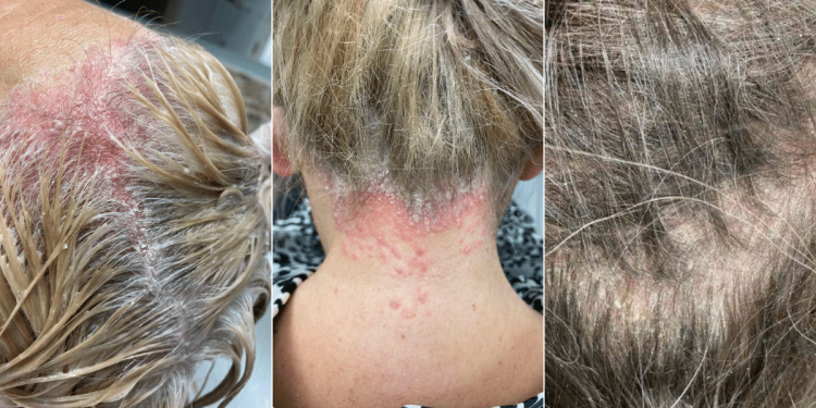 pikkelysomor_kezelese