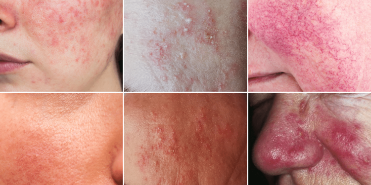 rosacea_kialakulasa_tunetei_es_kezelese rosacea_kialakulasa_tunetei_es_kezelese