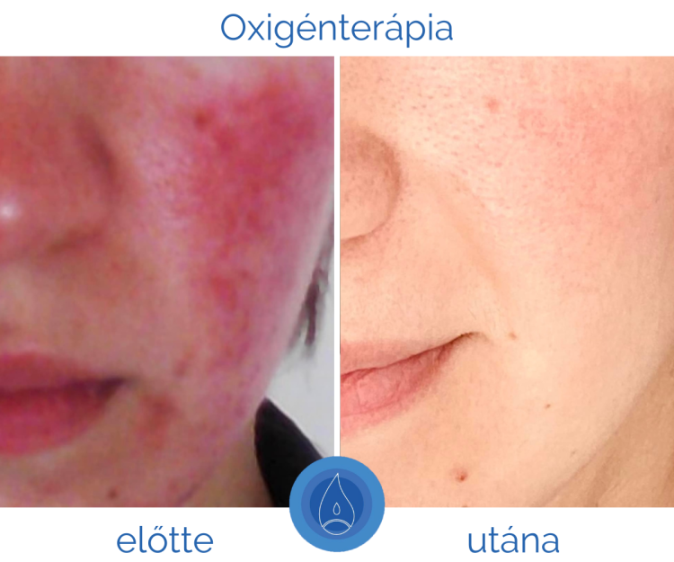 rosacea_kialakulasa_tunetei_es_kezelese rosacea_kialakulasa_tunetei_es_kezelese