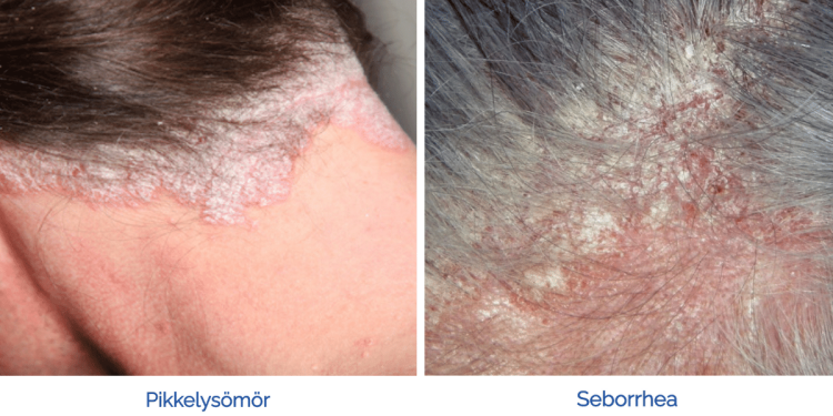 seborrhea_hogyan_ismerheto_fel_es_mi_a_megoldas