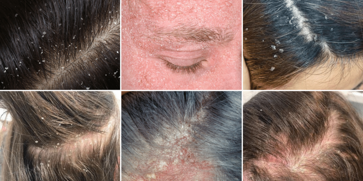 seborrhea_hogyan_ismerheto_fel_es_mi_a_megoldas