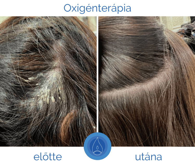 seborrhea_hogyan_ismerheto_fel_es_mi_a_megoldas