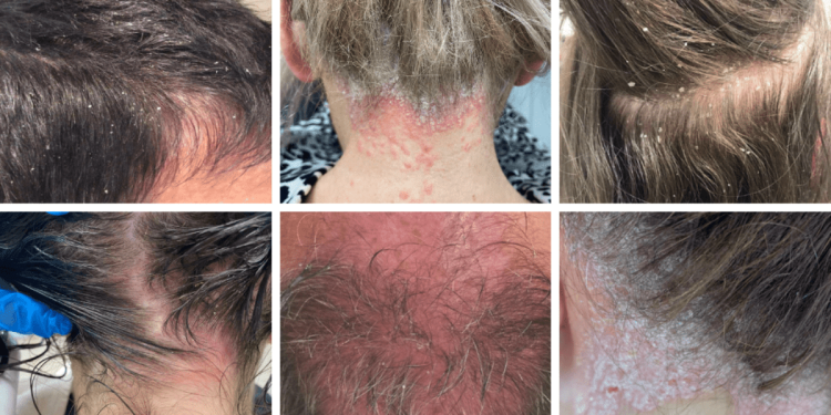 viszketo_fejbor_kialakulasanak_okai_es_kezelese viszketo_fejbor_kialakulasanak_okai_es_kezelese